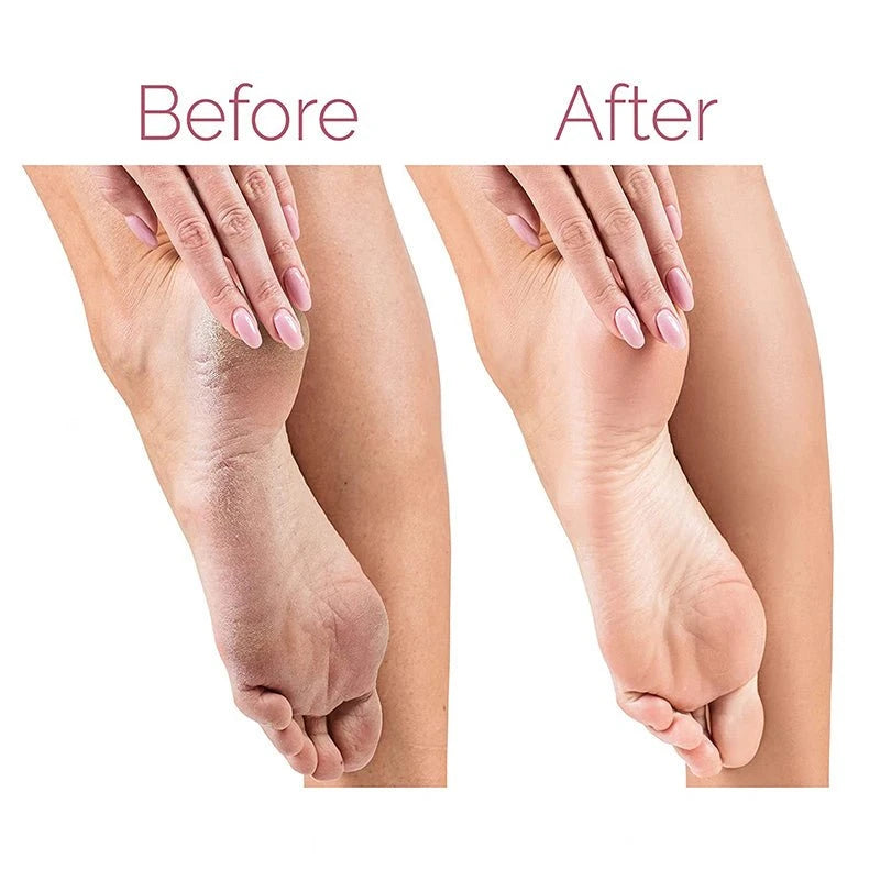 Rechargeable Electric Callus Remover
